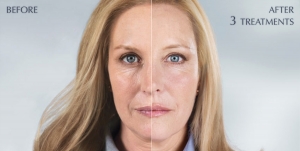 Sculptra Injections Cost: What to Expect and How to Budget